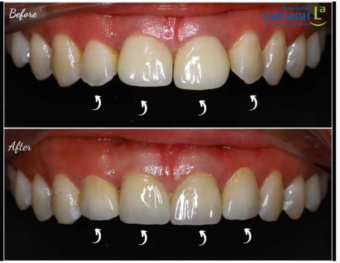 Răng sứ làm ở nơi khác, mới dùng vài tháng mà răng đã dịch chuyển, hở kẽ,… được làm lại tại nha khoa Lan Anh ạ