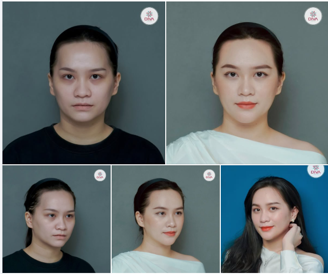 TỪ GƯƠNG MẶT HỐC HÁC, GIÀ TRƯỚC TUỔI ​​​​​​​ BIẾN HÓA THÀNH KHUÔN MẶT TRẺ TRUNG, TƯƠI TẮN NHỜ CẤY MỠ MẮT DƯỚI - CẤY MỠ CẰM