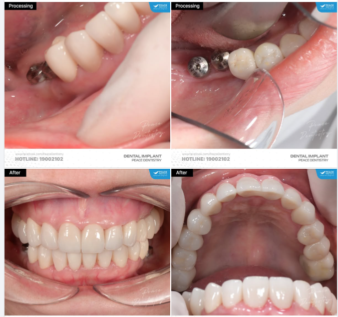 NẾU BIẾT TRỒNG RĂNG IMPLANT TỐT VÀ ĐƠN GIẢN THẾ NÀY THÌ CHỊ ĐÃ LÀM TỪ LÂU!