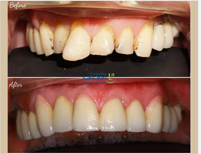 Nếu không tiện để niềng răng, đặc biệt là khi hình dạng và bề mặt răng của bạn cũng không đẹp, thì làm răng sứ sẽ đem lại kết quả tốt hơn ạ
