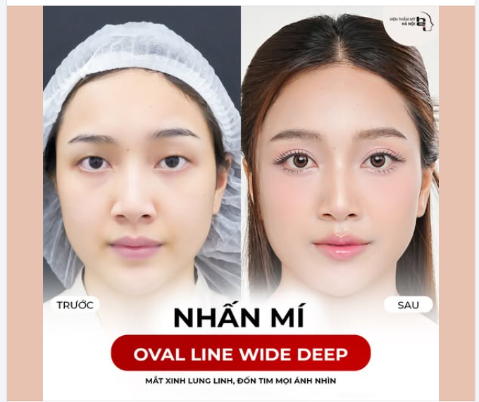 NHÂN MÍ OVAL LINE WIDE DEEP