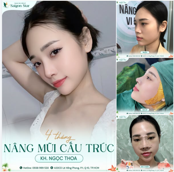 HÀNH TRÌNH 4 THÁNG "LỘT XÁC" VỚI DÁNG MŨI CẤU TRÚC – TẠM BIỆT MŨI TẸP, ĐÓN CHÀO MŨI CAO THANH TÚ