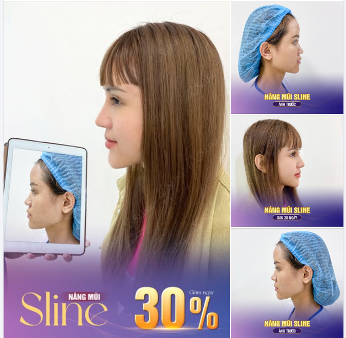 HÀNH TRÌNH NÂNG MŨI SLINE – THAY ĐỔI ĐỂ TỰ TIN HƠN