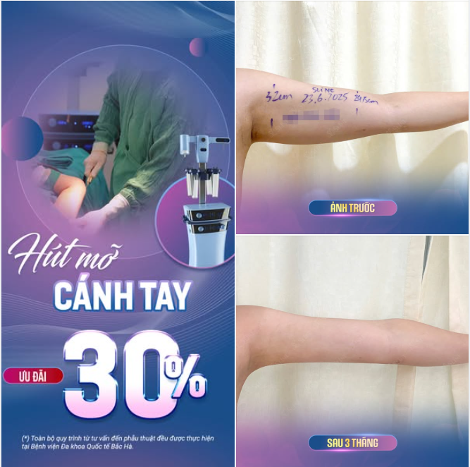 HÚT MỠ CÁNH TAY – TỰ TIN DIỆN MỌI KIỂU TRANG PHỤC