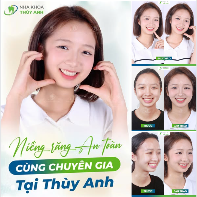 NIỀNG XONG NGỠ BẬT FILTER ĐỜI THỰC