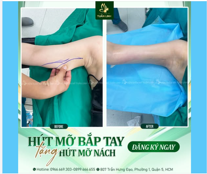 Hút mỡ bắp tay TẶNG NGAY hút mỡ nách!!