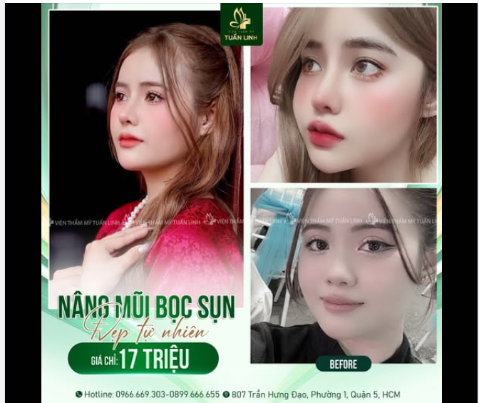 Nâng mũi bọc sụn chỉ 17TR - An toàn- Đẹp tự nhiên.