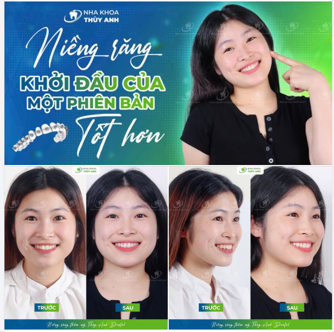 BÍ QUYẾT CHỈNH RĂNG KHẤP KHỂNH ĐỂ TỰ TIN KHOE NỤ CƯỜI RẠNG RỠ
