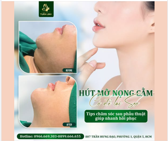 Hút mỡ nọng cằm có để lại sẹo không? Tips chăm sóc sau phẫu thuật để nhanh hồi phục!!