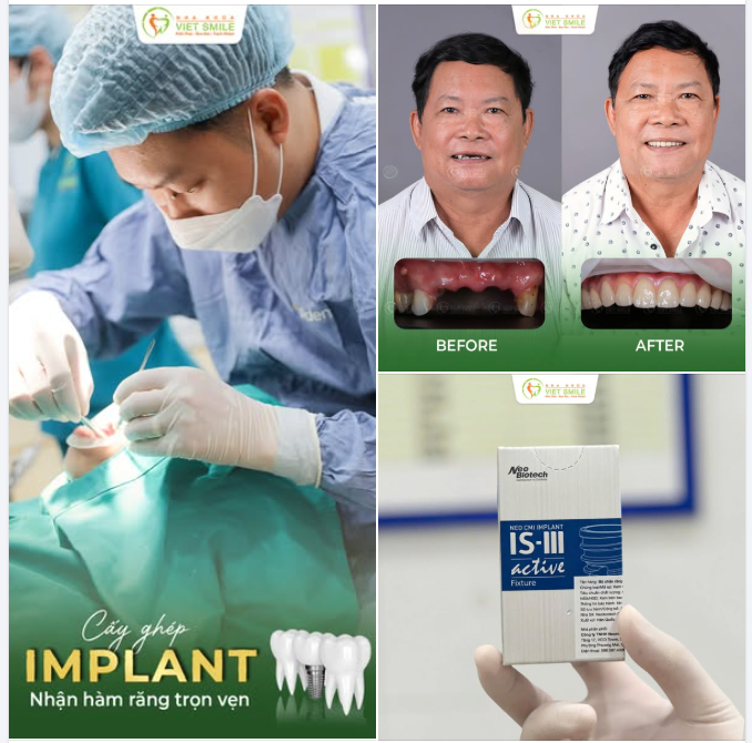 CẤY IMPLANT – LẤY LẠI NỤ CƯỜI, KHÔI PHỤC ĂN NHAI
