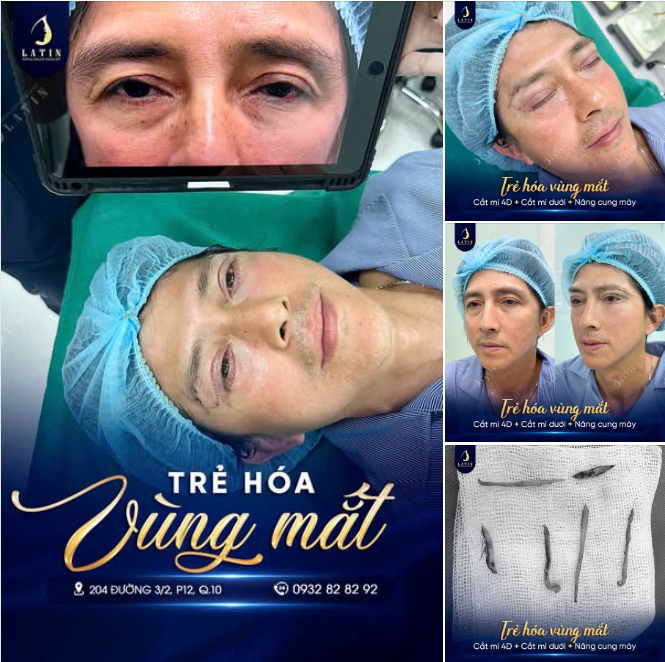 Trẻ hóa vùng mắt – Lấy lại phong độ ở tuổi U50