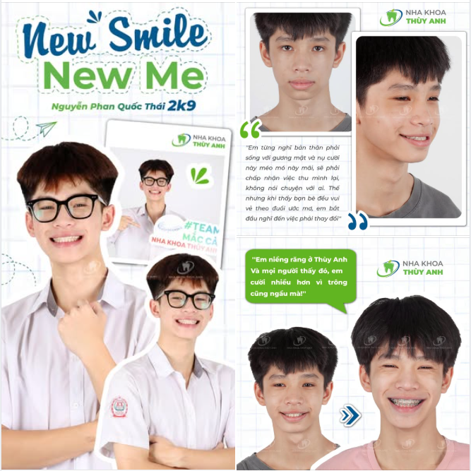 ''GIỮ CHUỖI'' NIỀNG RĂNG, RINH NỤ CƯỜI CHUẨN XỊN