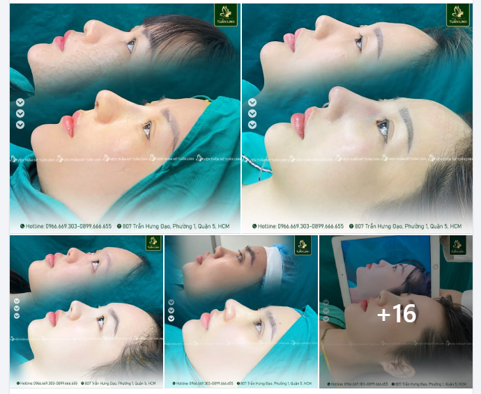 20 CASE NÂNG MŨI TRONG NGÀY TẠI TUẤN LINH!!