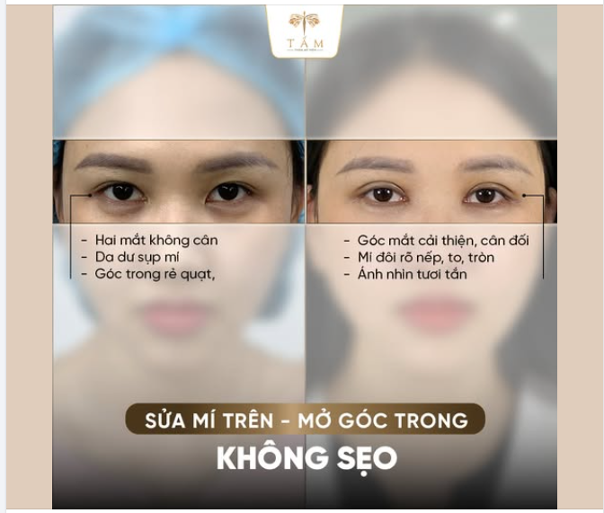 Sửa lại Mí Trên và Mở Góc Mắt Trong Không Sẹo giúp gương mặt khách hàng tươi tắn và rạng rỡ hơn rất nhiều.