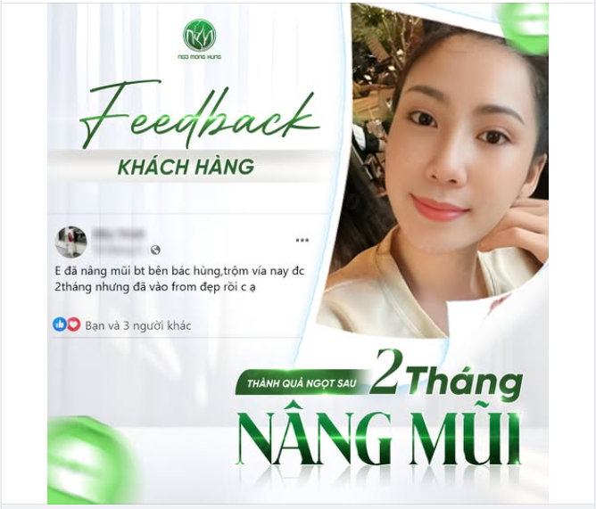 Khách hàng Feedback sau 2 tháng nâng mũi