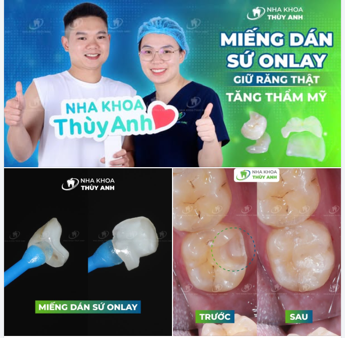KHẮC PHỤC RĂNG SÂU LỚN VỚI MIẾNG TRÁM SỨ INLAY/ONLAY