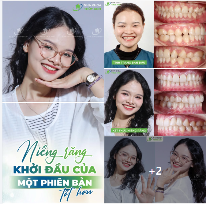 DÁM THAY ĐỔI ĐỂ TOẢ SÁNG - CÂU CHUYỆN NIỀNG RĂNG CỦA BÁC SĨ LÂM TẠI NHA KHOA THUỲ ANH