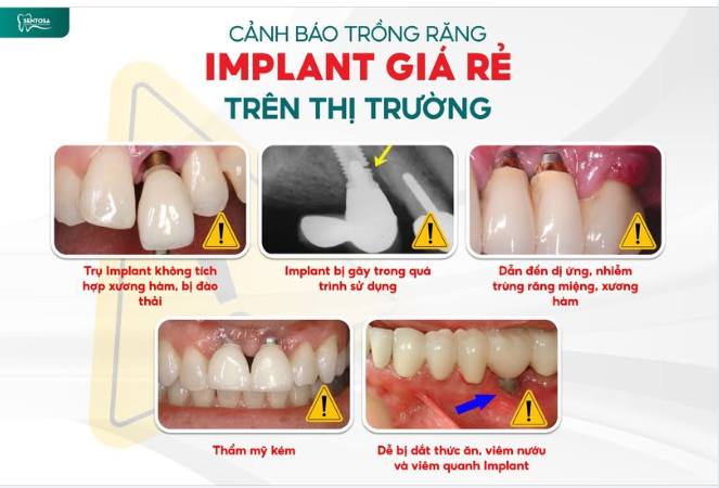 CẢNH BÁO TRỒNG RĂNG IMPLANT GIÁ RẺ TRÊN THỊ TRƯỜNG
