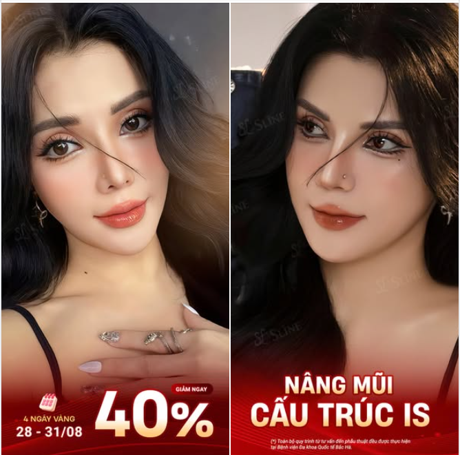 NÂNG MŨI CẤU TRÚC IS – DEAL ĐỈNH TRONG 4 NGÀY VÀNG