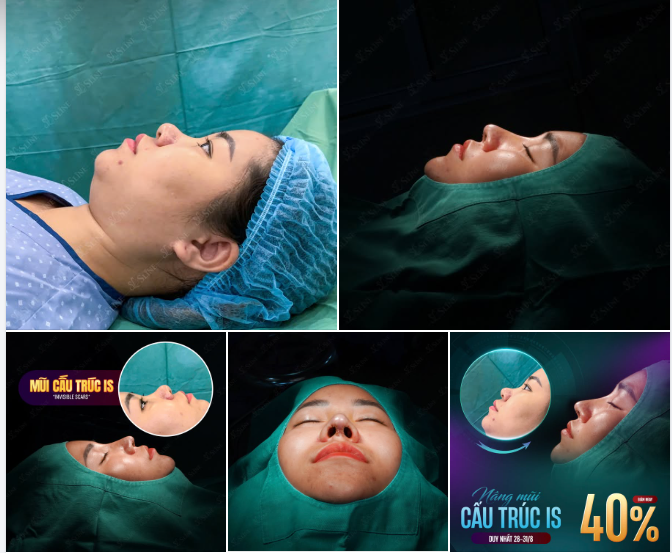 NGÀY VÀNG – KHÁCH HÀNG HẠNH PHÚC VỚI DÁNG MŨI MỚI