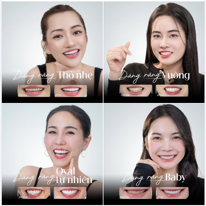 Dáng răng cũng như phong cách – bí mật làm nên thần thái của nụ cười