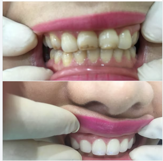 Những lưu ý sau khi làm răng sứ thẩm mỹ
