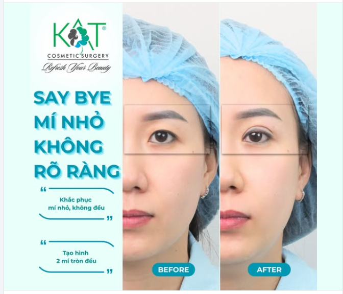 “Đẹp hơn chỉ cách một lần nhấn mí”