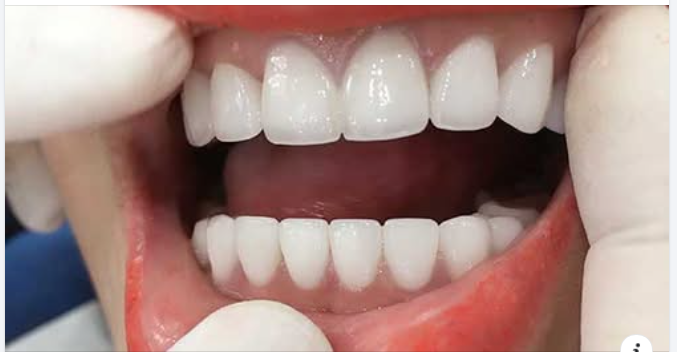 So Sánh Hàm Giả Tháo Lắp Và Trồng Răng Implant