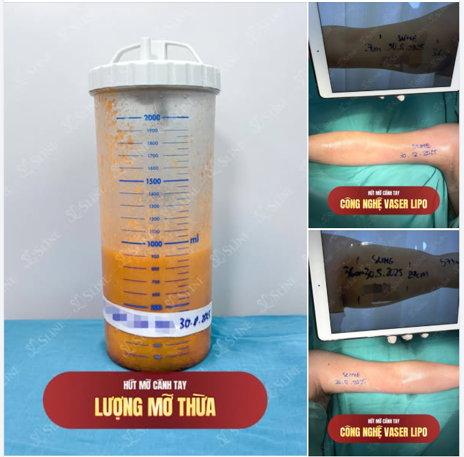 HÚT MỠ CÁNH TAY – CÔNG NGHỆ VASER LIPO
