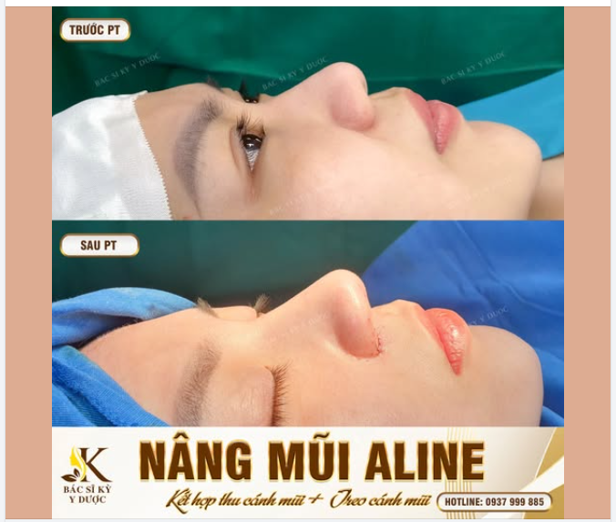 Dáng Mũi ALINE này có làm ai đắm say  Vừa mới hoàn thành thôi mà dáng mũi đã: