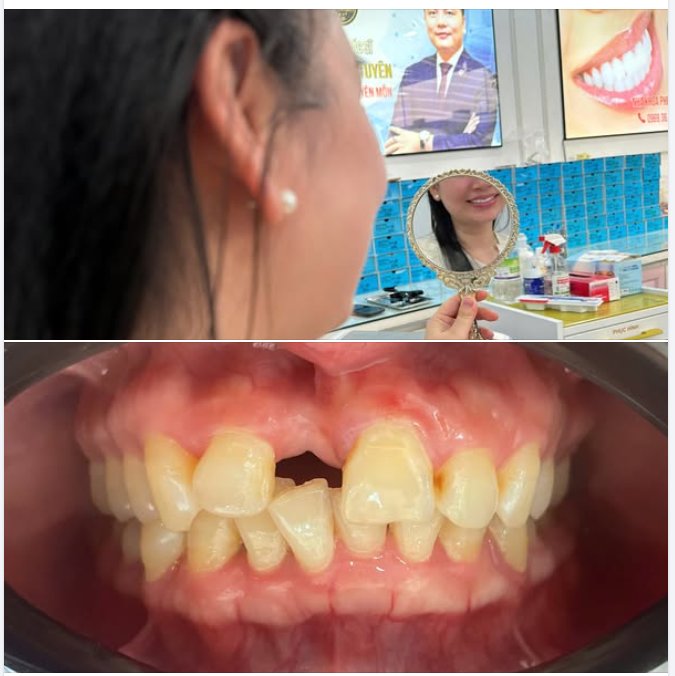 Làm răng sứ nhanh nhất mất bao lâu?