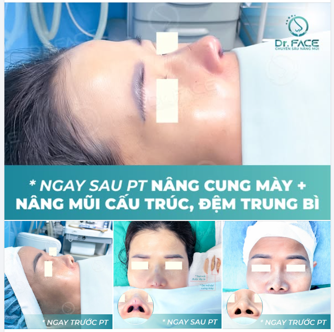 COMBO trẻ trung, xinh đẹp “2 trong 1”: NÂNG MŨI + NÂNG CUNG MÀY