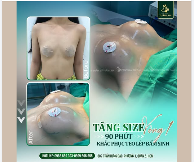 Giải pháp khắc phục vòng 1 teo lép bẩm sinh – Sở hữu khuôn ngự.c đầy đặn, quyến rũ chỉ sau 1 lần thực hiện!