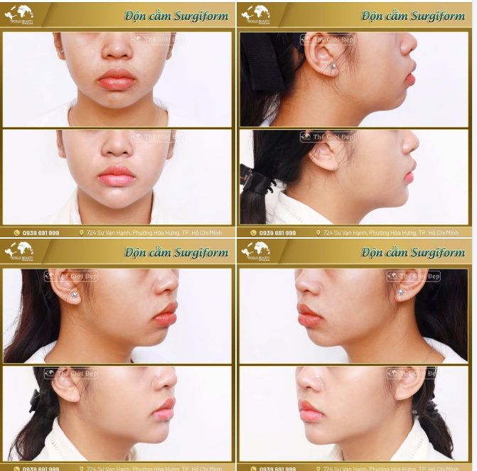 Không cần “đại tu” toàn bộ gương mặt, đôi khi chỉ một điểm nhỏ như chiếc cằm cũng đủ để tạo nên sự khác biệt rõ rệt về đường nét và tổng thể.