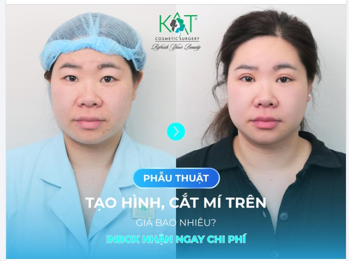 Nhấn mí giúp tạo nếp mí rõ ràng, khắc phục tình trạng mắt một mí, mí lót, mang lại đôi mắt to tròn, tự nhiên và cuốn hút hơn mà không cần phẫu thuật.