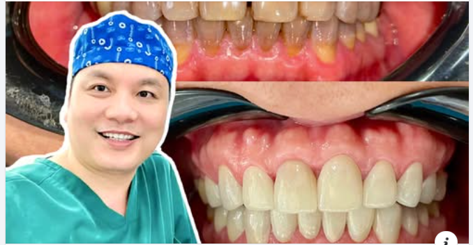 Bọc răng sứ giữ được bao lâu và hướng dẫn chăm sóc sau bọc răng