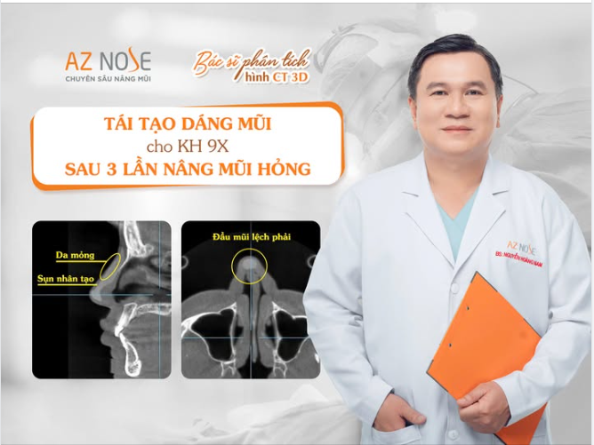 Tư vấn tái tạo dáng mũi cho khách hàng 9X sau 3 lần nâng mũi h..ỏng