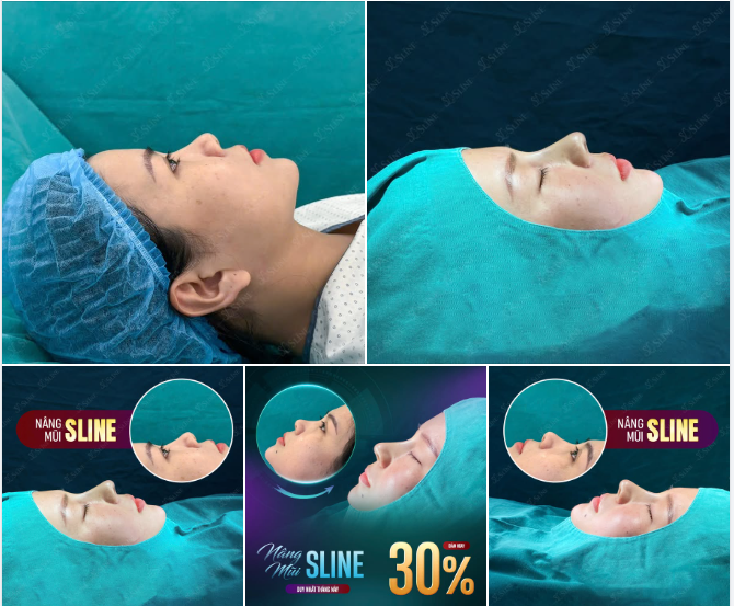 NÂNG MŨI SLINE – SẮC MŨI THANH TÚ, THANH LỊCH
