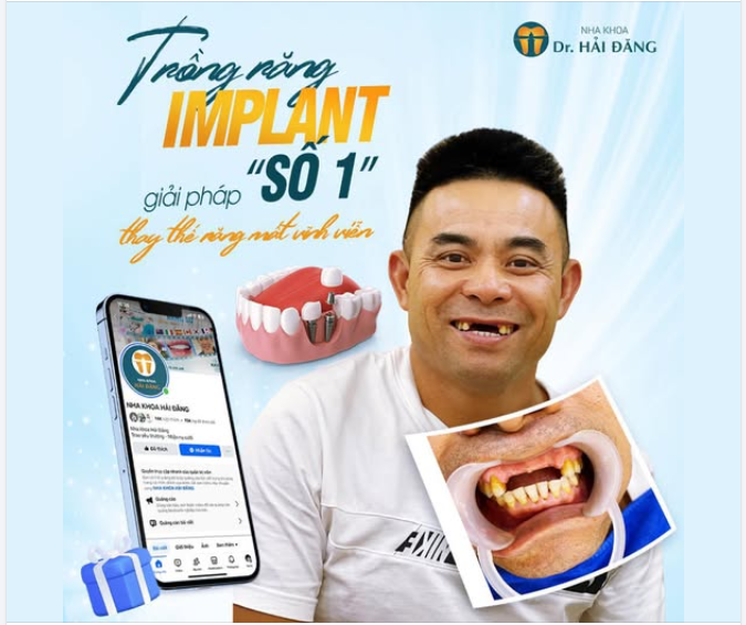 Mất răng? Đừng lo!  Trồng răng Implant – giải pháp số 1 thay thế răng mất vĩnh viễn.