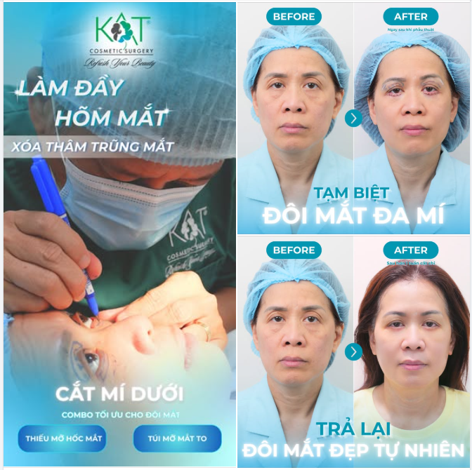 Hốc mắt trũng, quầng thâm, bọng mỡ làm bạn trông mệt mỏi??