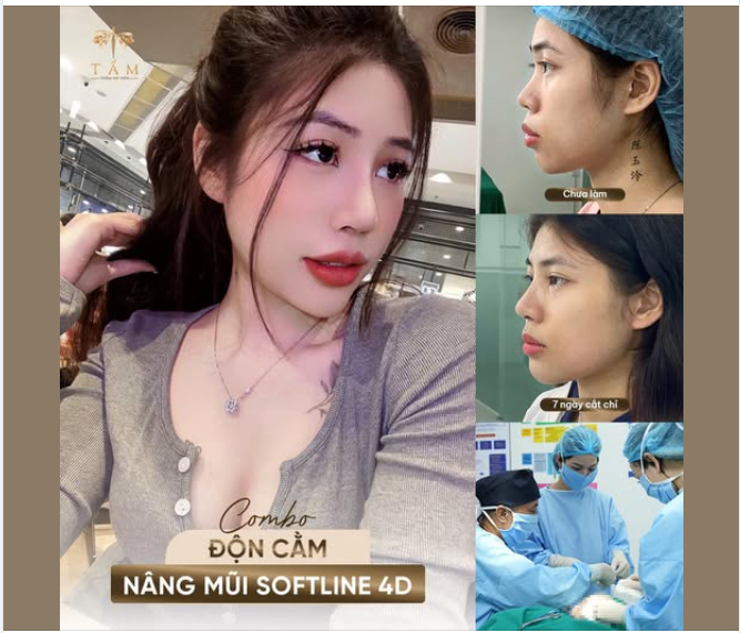 "Sau đại lễ, em tranh thủ đi tái khám tròn 1 tháng làm combo mũi - cằm.