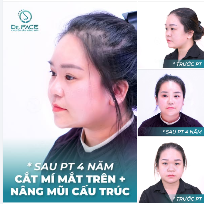 Tự hào được NGƯỜI CÙNG NGÀNH tin tưởng chọn làm COMBO MŨI - MẮT