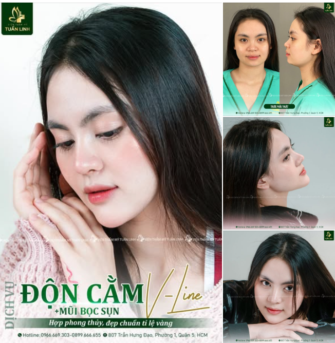 Combo Nâng mũi + Độn cằm Thiết kế gương mặt đẹp hoàn hảo, sắc nét, cuốn hút.