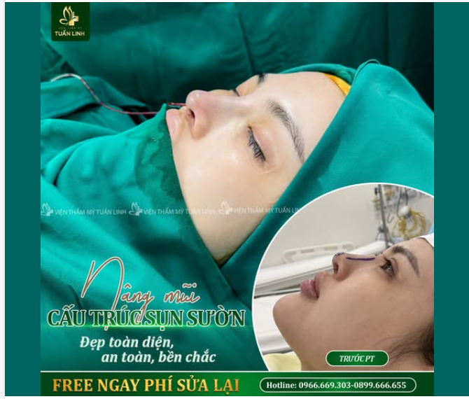 Nâng mũi cấu trúc sụn sư.ờn - Tái tạo mũi hỏng đẹp hoàn hảo!!!