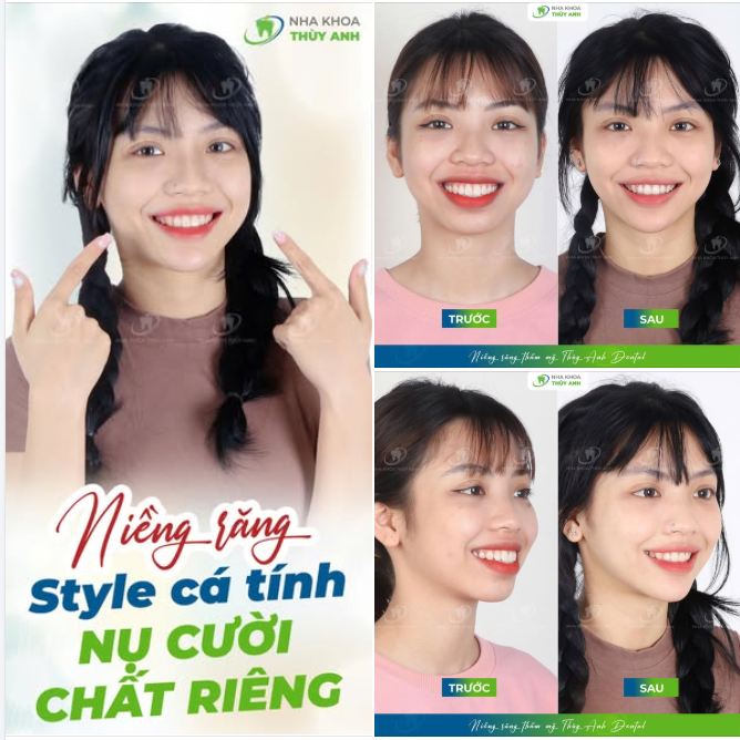 TUỔI TRẺ - SỐNG CHẤT, NHẤT ĐỊNH KHÔNG ĐỂ RĂNG HÔ LÀM GIẢM VISUAL!