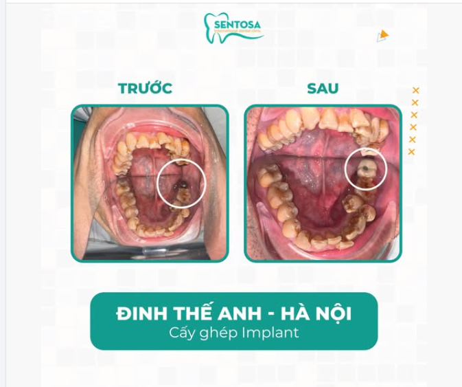 ĐỪNG CHỦ QUAN VỚI SÂU RĂNG – BÀI HỌC TỪ TRƯỜNG HỢP ANH ĐINH THẾ ANH