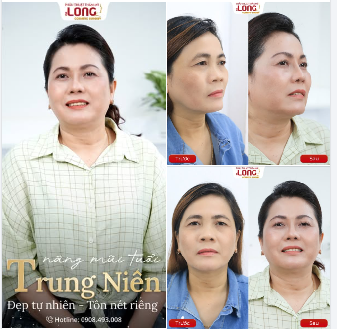 NÂNG MŨI “TUỔI TRUNG NIÊN”