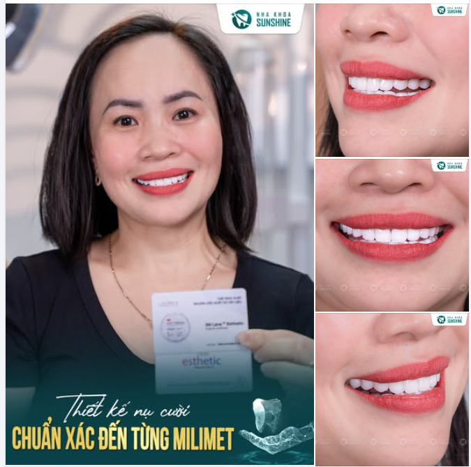 Một nụ cười đẹp không chỉ nằm ở màu sắc răng trắng sáng, mà còn là tỉ lệ hoàn hảo giữa từng chiếc răng, dáng môi và khuôn mặt.