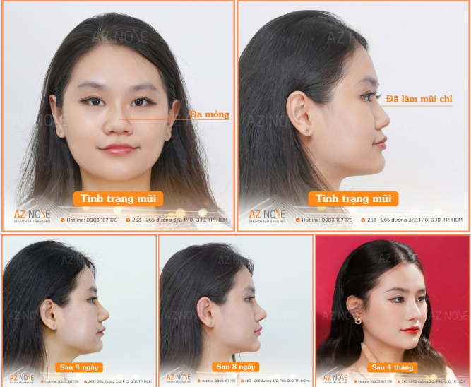 Không còn dáng mũi “ngắn hạn” vì nâng chỉ