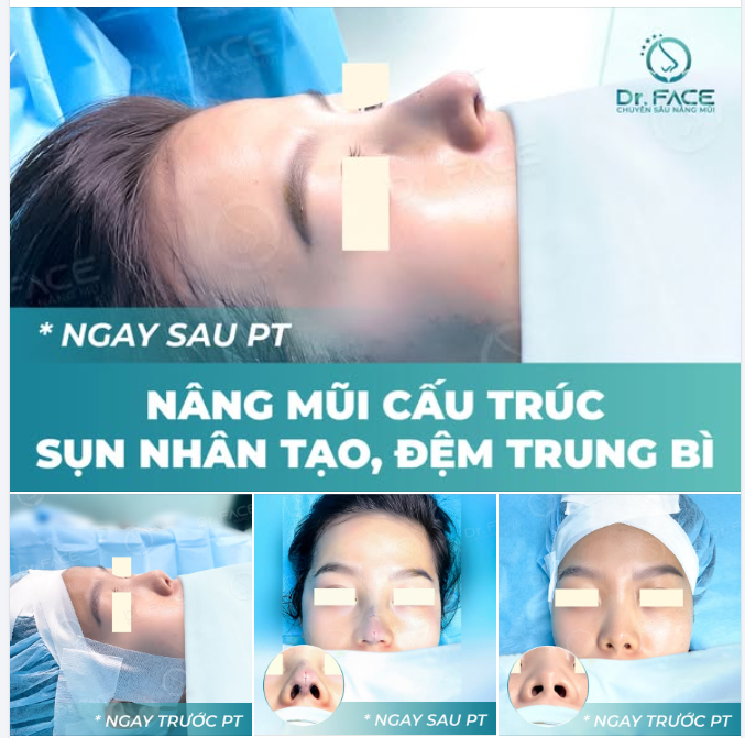 TẠM BIỆT MŨI SIÊU HẾCH, CHÀO DÁNG MŨI TỰ TIN